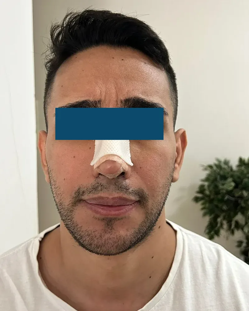 Rosto de paciente com 4 dias de pós-operatório, olhos cobertos por tarja