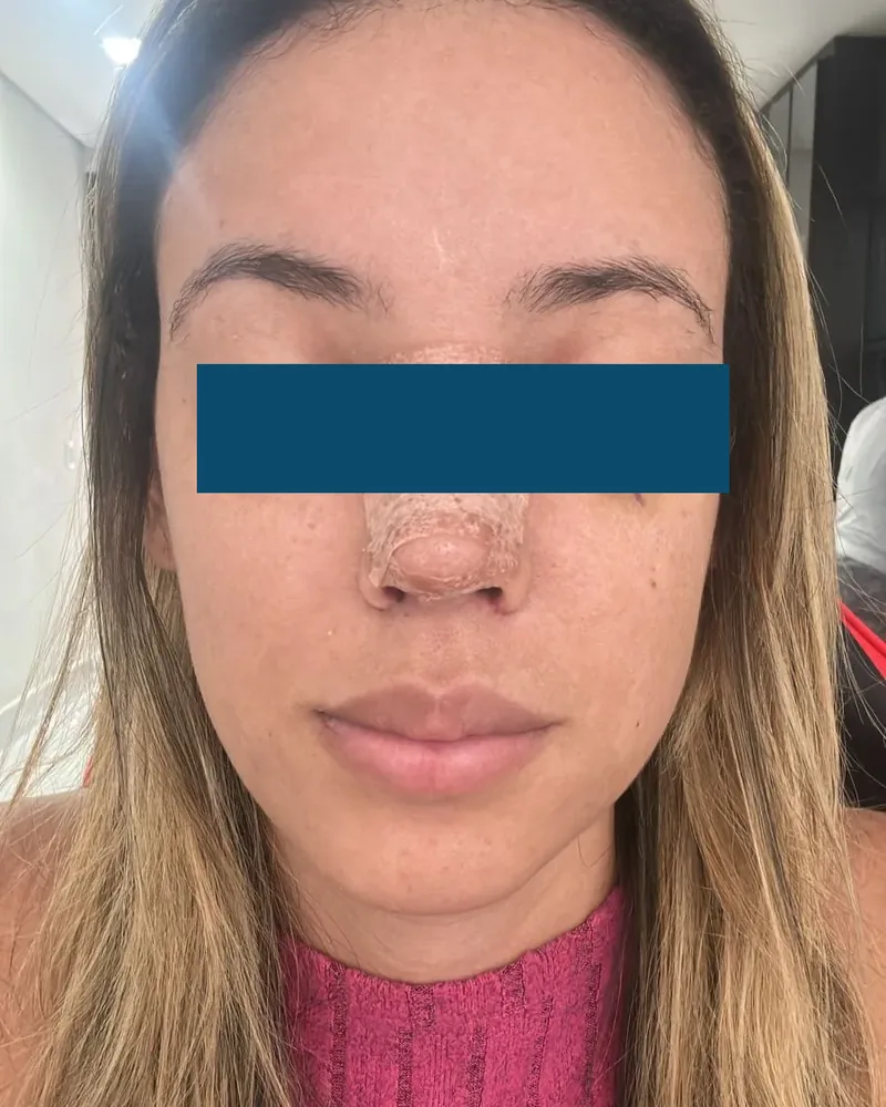 Rosto de paciente com 7 dias de pós-operatório, olhos cobertos por tarja