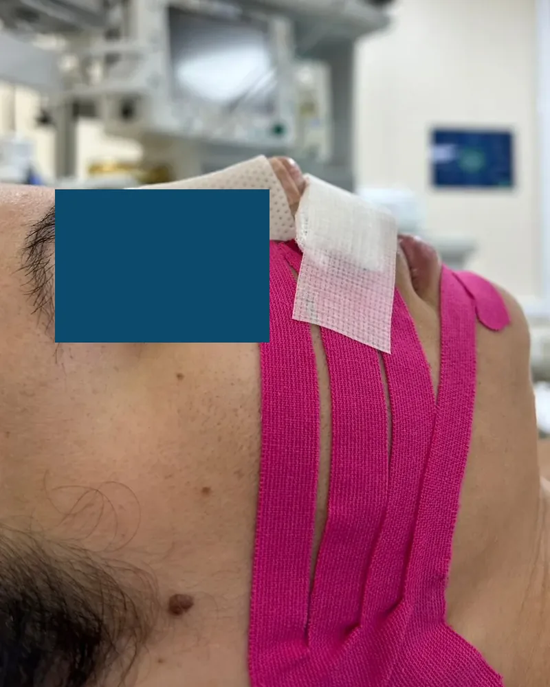 Paciente com taping linfático aplicado no rosto logo após o procedimento, olhos cobertos por tarja